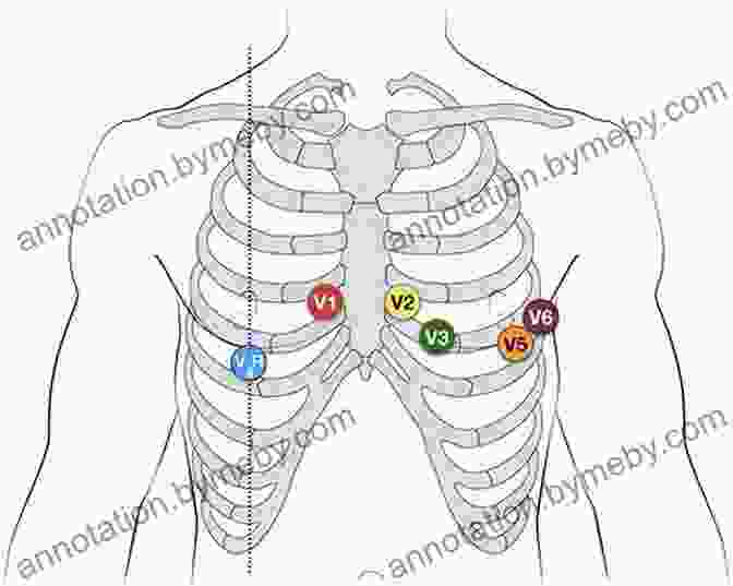 Lead Placement EKG/ECG Interpretation: A Complete Step By Step Beginner S Guide To A Rapid Interpretation Of The 12 Lead EKG And On How To Diagnose And Treat Arrhythmias